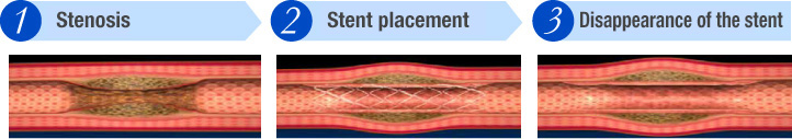 （1）Stenosis　（2）Stent placement　（3）Disappearance of the stent